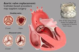 Aortic Valve Replacement at Livasa Mohali - TAVI Without Open Surgery